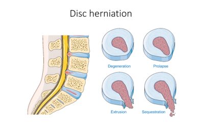 Comment soigner une hernie discale