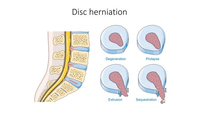 Comment soigner une hernie discale